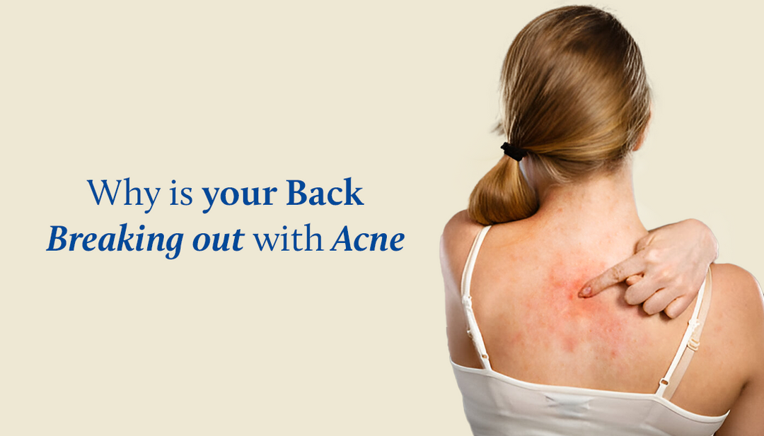 8 Everyday habits that may be causing you Back Acne