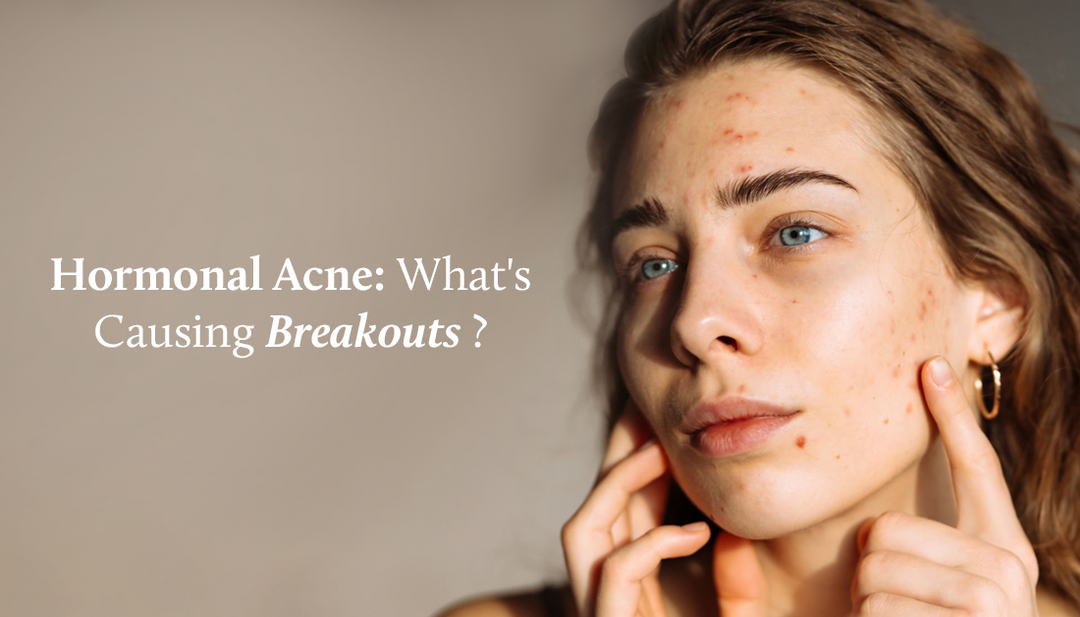 The woman is pointing to her face, highlighting her hormonal acne.