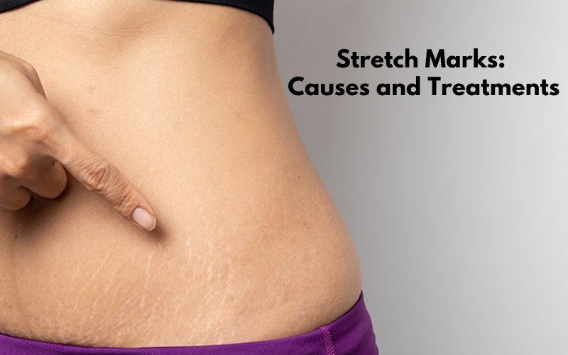 Why do stretch marks appear and how to treat them? - Blue Nectar Ayurved