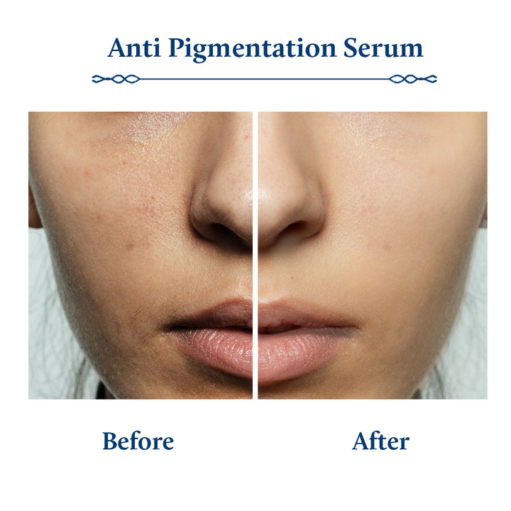 Anti pigmentation Serum